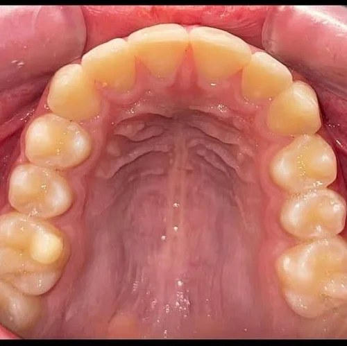 دندان ارتودنسی شده