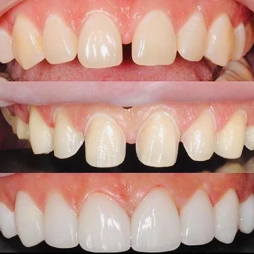 کامپوزیت دندان در اصفهان