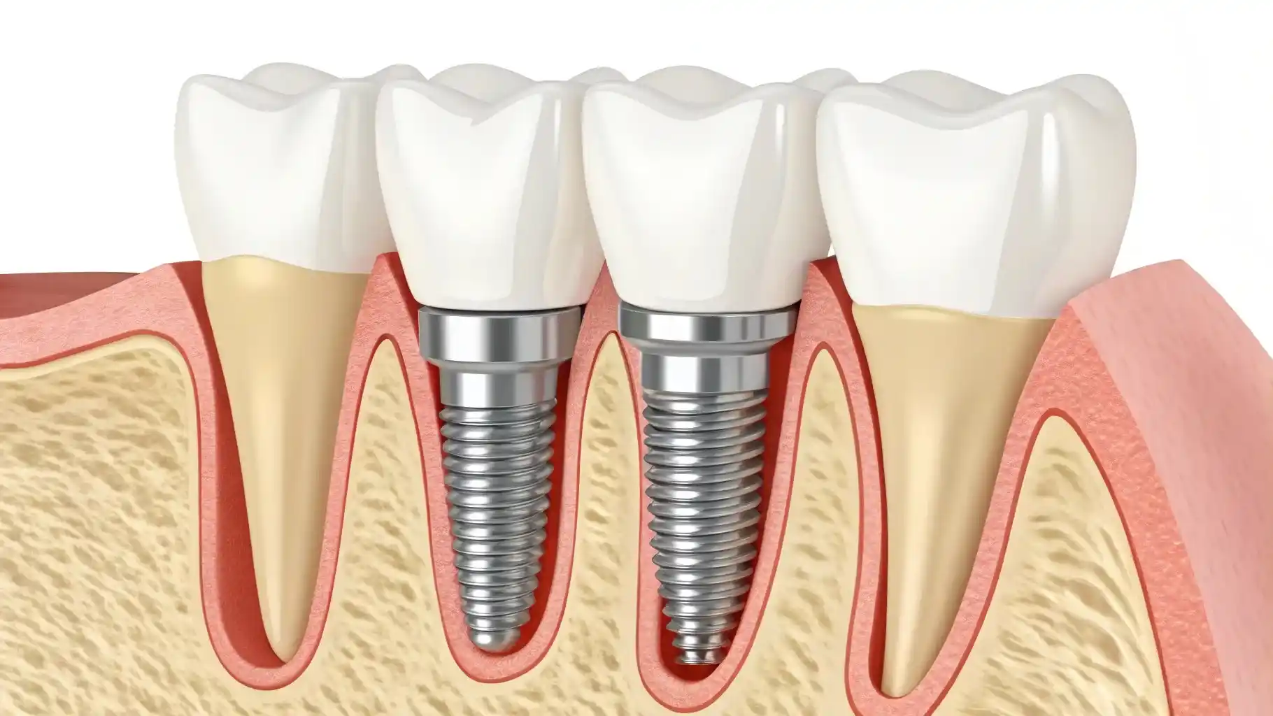 جراحی ایمپلنت دندان