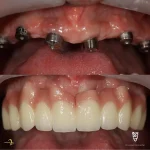 ایمپلنت دندان