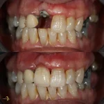 ایمپلنت دندان