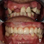 ایمپلنت دندان