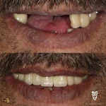 ایمپلنت دندان