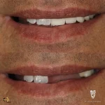 ایمپلنت دندان